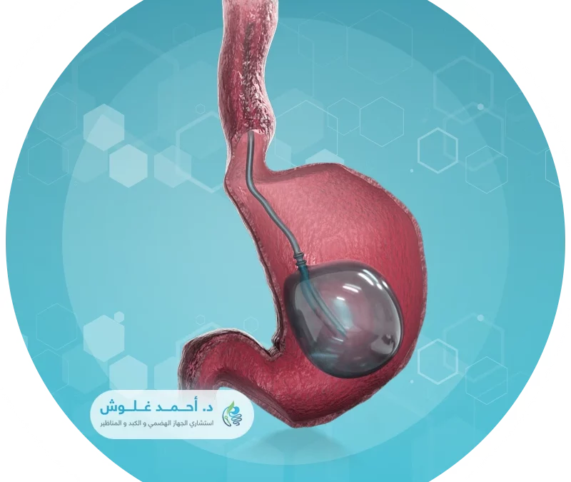 بالون المعدة