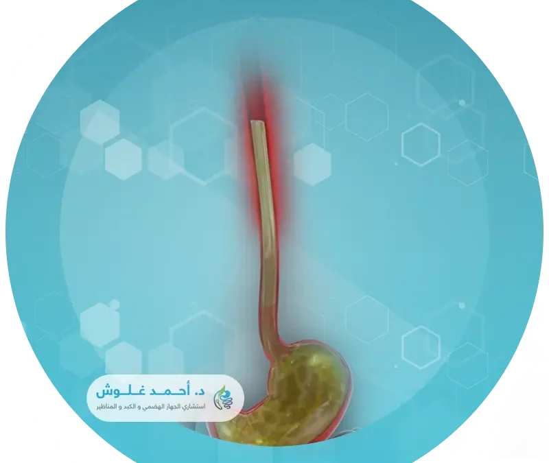 تقنية آرما ARMA لعلاج ارتجاع المريء