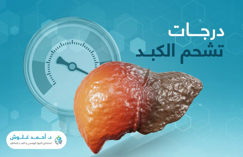 ما درجات تشحم الكبد؟ وكيف يُعالج؟ 
