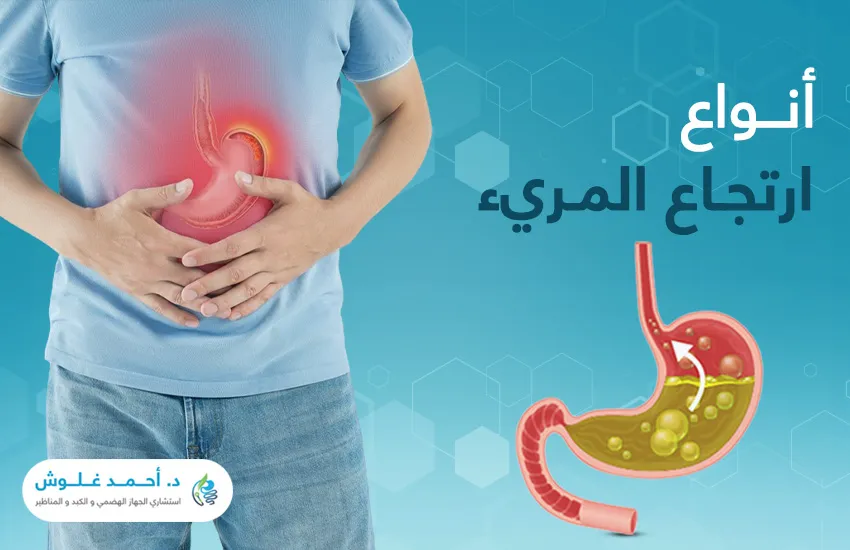 انواع ارتجاع المريء… أخطرها الارتجاع الصامت!