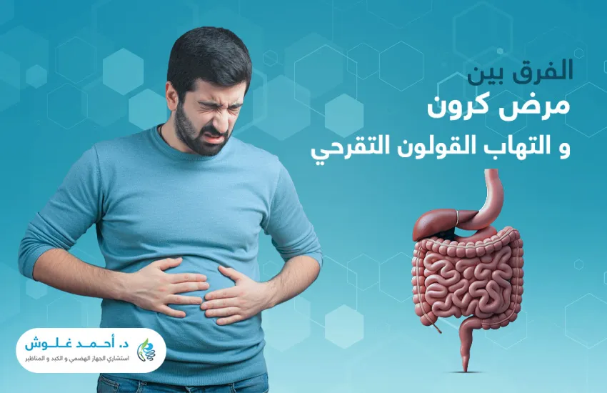 ما الفرق بين مرض كرون والتهاب القولون التقرحي؟