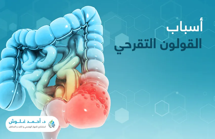 هل يمكنني السيطرة على أسباب القولون التقرحي؟